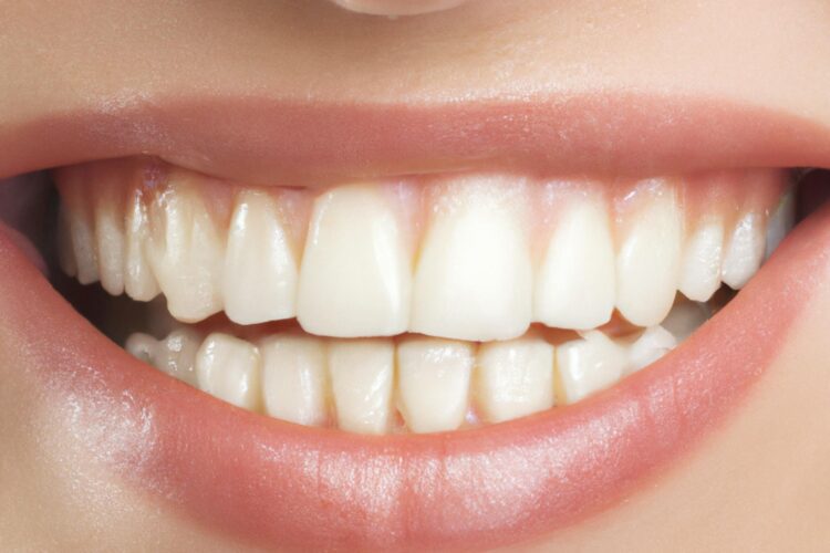 A close up of the teeth of a woman smiling